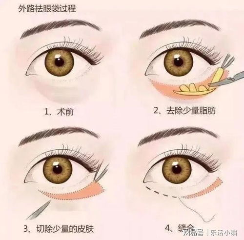 外切眼袋手术多久才能完全恢复:外切眼袋手术多久才能完全恢复?全面了解恢复期 外切眼袋手术多久才能完全恢复:外切眼袋手术多久才能完全恢复?全面了解恢复期