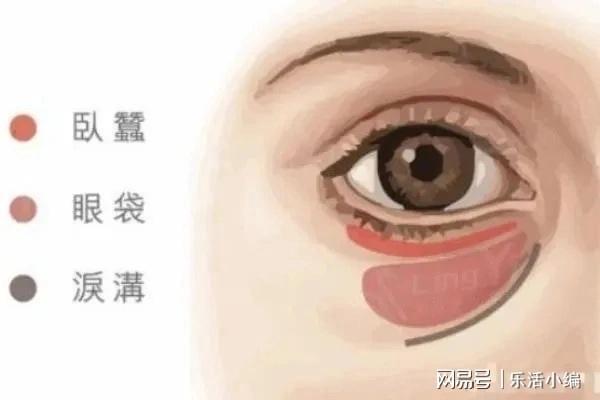 外切眼袋手术多久才能完全恢复:外切眼袋手术多久才能完全恢复?全面了解恢复期 外切眼袋手术多久才能完全恢复:外切眼袋手术多久才能完全恢复?全面了解恢复期