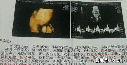 b超单子看男女:B超单子看男女,科学与伦理的边界