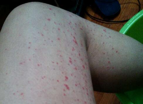 性疾病皮肤有哪些特征：皮肤病的警示信号，这些皮肤特征可能预示着疾病