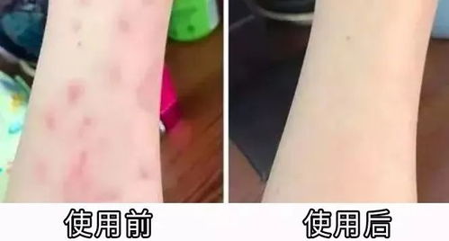 各种疹子图片:图解各种常见疹子,从湿疹到荨麻疹,一张图看懂皮肤异常