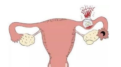 宫外怀孕几天能查出来:宫外孕几天能查出来?血HCG检查是关键!
