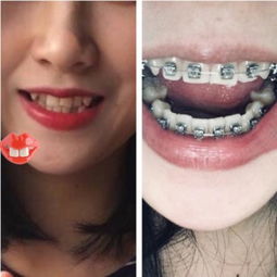 做牙齿矫正大概费用是多少:牙齿矫正费用全解析,影响价格的关键因素与参考标准