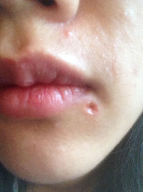 千万不要激光点痣后悔一辈子:千万不要激光点痣!后悔一辈子的代价,你承受得起吗?