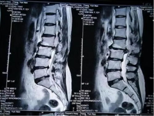 怎样判断自己得了腰椎间盘突出:腰痛困扰?教你几招初步判断是否得了腰椎间盘突出