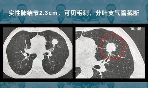莫西沙星能治肺结节吗:莫西沙星能治肺结节吗?需明确适应症与医生指导