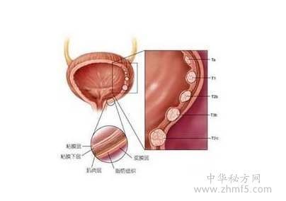 鸦胆子治疣的方法配方:鸦胆子,中药外敷治疣的有效方法与配方详解 鸦胆子治疣的方法配方:鸦胆子,中药外敷治疣的有效方法与配方详解