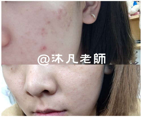 多西环素治痘痘吃多久：多西环素治痘痘到底要吃多久？