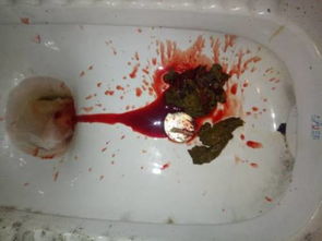 大便带血附在粪便表面:大便带血附在表面,这些原因你必须知道 大便带血附在粪便表面:大便带血附在表面,这些原因你必须知道