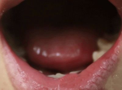 艾滋病初期嘴唇图片：艾滋病初期嘴唇症状及图片解读