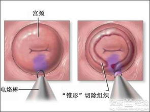 慢性宫颈炎能自愈吗:慢性宫颈炎能自愈吗?这些情况要注意