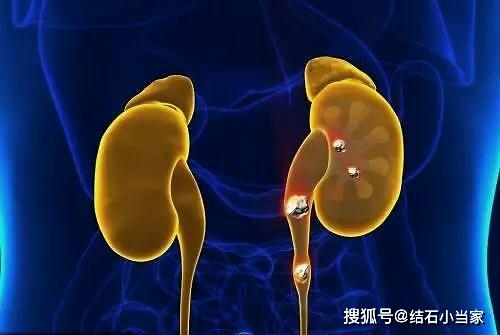 女人肾结石最明显的症状:女性肾结石最明显的症状,你了解吗?