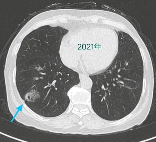 肺结节吃什么消结节最快最好：肺结节吃什么消结节最快最好？饮食调理辅助健康，但需科学治疗！