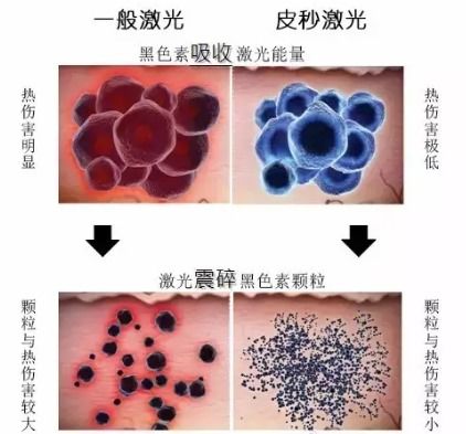 排色素要多久排干净:排色素到底要多久才能排干净? 排色素要多久排干净:排色素到底要多久才能排干净?