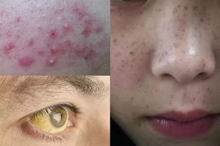 排色素要多久排干净：排色素到底要多久才能排干净？