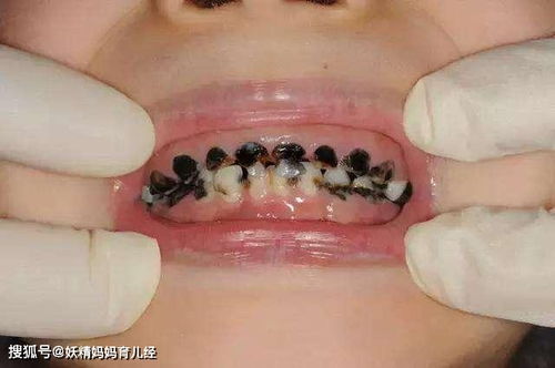 梦见满嘴牙齿掉光了并全部吐出：解密梦境，梦见满嘴牙齿掉光并全部吐出