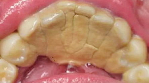 梦到牙齿松动然后用手拔掉了:梦到牙齿松动后亲手拔除,一场潜意识的自我疗愈之旅 梦到牙齿松动然后用手拔掉了:梦到牙齿松动后亲手拔除,一场潜意识的自我疗愈之旅