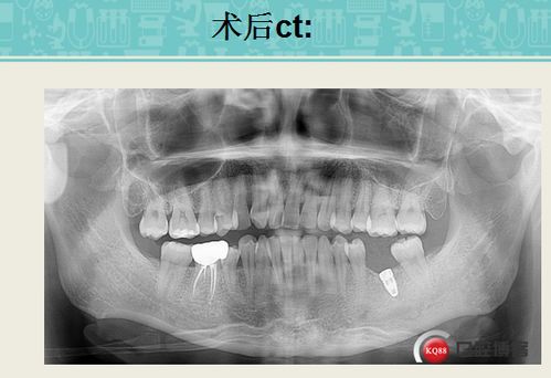 梦到牙齿松动然后用手拔掉了:梦到牙齿松动后亲手拔除,一场潜意识的自我疗愈之旅