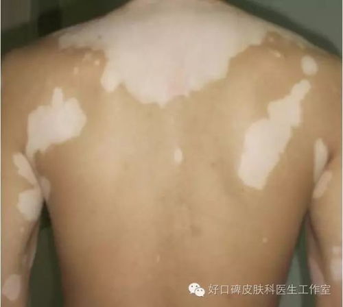 照308白斑恢复过程:308nm准分子激光治疗白癜风的恢复过程与效果分析 照308白斑恢复过程:308nm准分子激光治疗白癜风的恢复过程与效果分析