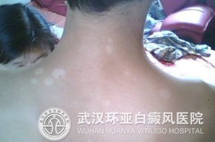 白斑黑色素长出的规律:揭秘白斑黑色素长出的规律,从理解到治疗新思路