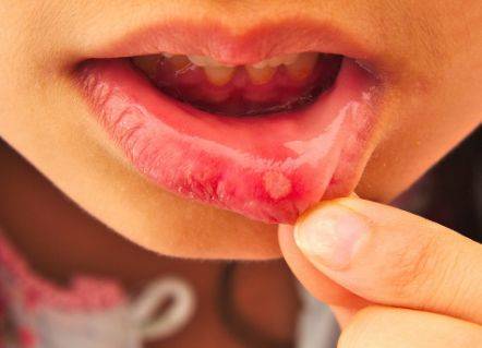 口腔溃疡最佳治疗方法:口腔溃疡反复困扰?这5种方法可能是最佳治疗方案 口腔溃疡最佳治疗方法:口腔溃疡反复困扰?这5种方法可能是最佳治疗方案