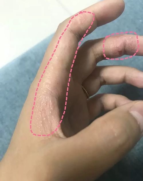 手上长水泡湿疹的图片:手上的水泡湿疹,原因、症状与处理指南