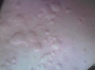 荨麻疹是如何患上的:荨麻疹是如何患上的?七大常见诱因解析