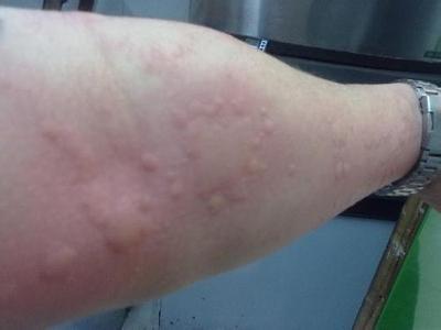 荨麻疹是如何患上的:荨麻疹是如何患上的?七大常见诱因解析 荨麻疹是如何患上的:荨麻疹是如何患上的?七大常见诱因解析