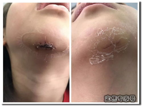 术后去疤痕最佳时间:掌握时机是关键,术后去疤痕的最佳时间指南