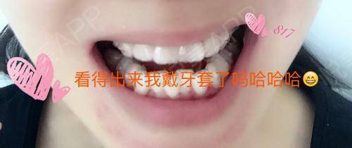 梦见下牙掉了好多颗是怎么回事:解密,梦见下牙掉了好多颗是怎么回事? 梦见下牙掉了好多颗是怎么回事:解密,梦见下牙掉了好多颗是怎么回事?