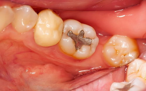 梦见下牙掉了好多颗是怎么回事:解密,梦见下牙掉了好多颗是怎么回事? 梦见下牙掉了好多颗是怎么回事:解密,梦见下牙掉了好多颗是怎么回事?