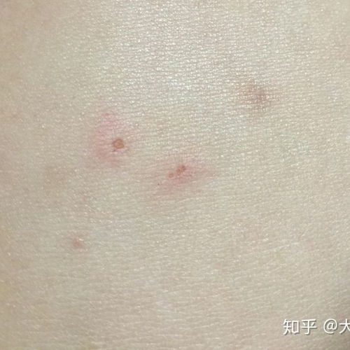 怎么判断被螨虫咬了:被螨虫咬了怎么办?这些症状和判断方法你必须知道!