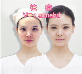 怎么把痘印消除:彻底告别痘印困扰!这5步科学祛痘印方案,你值得拥有 怎么把痘印消除:彻底告别痘印困扰!这5步科学祛痘印方案,你值得拥有