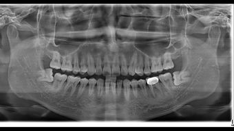 拔智齿多少钱一颗2021价格表:拔智齿到底多少钱一颗?2021年价格表全解析
