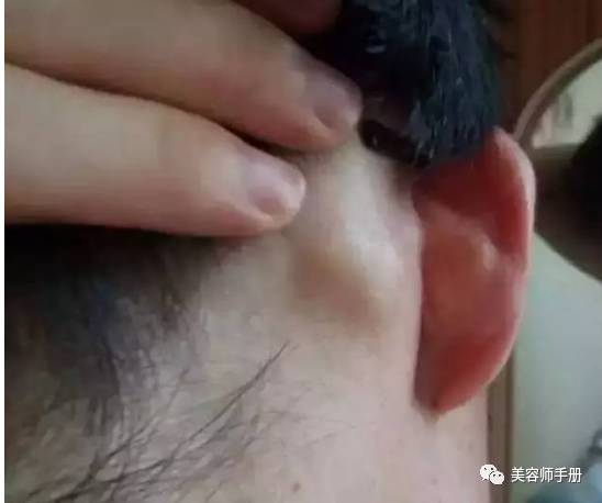 耳后淋巴癌早期症状图有鼓包:警惕!耳后出现这些鼓包可能是淋巴癌早期信号?详解耳后淋巴癌早期症状与表现 耳后淋巴癌早期症状图有鼓包:警惕!耳后出现这些鼓包可能是淋巴癌早期信号?详解耳后淋巴癌早期症状与表现