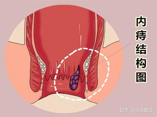 女性痔疮图片什么样子:女性痔疮长什么样?揭开常见症状的面纱