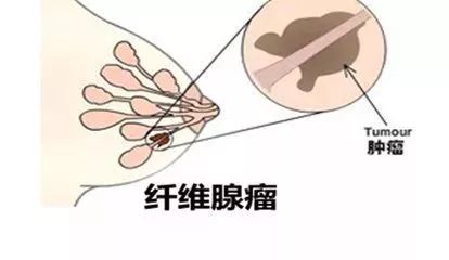 女人颈椎病的症状:女性颈椎病的常见症状及早发现早治疗的重要性 女人颈椎病的症状:女性颈椎病的常见症状及早发现早治疗的重要性