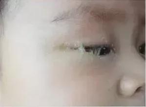 左眼皮跳了20多天预示着什么:左眼皮跳20多天是吉兆还是凶兆?传统文化与现代科学的解读