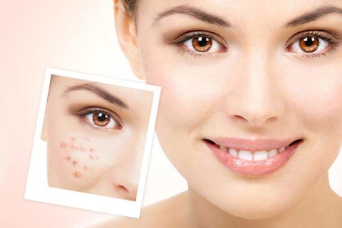 黄褐斑人工提取后脸会变红吗:黄褐斑人工提取治疗后,你的脸真的会变红吗? 黄褐斑人工提取后脸会变红吗:黄褐斑人工提取治疗后,你的脸真的会变红吗?