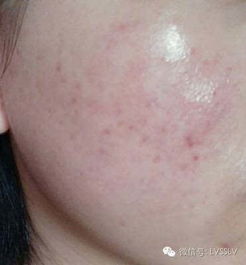 后背长痘痘要警惕三种病:后背长痘痘,别忽视!这三种病需要警惕 后背长痘痘要警惕三种病:后背长痘痘,别忽视!这三种病需要警惕