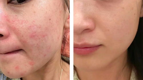 过敏怎么办怎么快速消除:过敏了怎么办?这些急救方法让你快速缓解不适! 过敏怎么办怎么快速消除:过敏了怎么办?这些急救方法让你快速缓解不适!