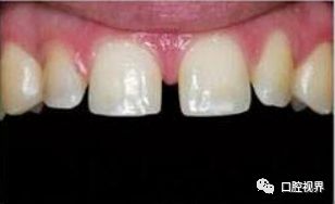 烤瓷牙和全瓷牙的区别哪个好:烤瓷牙和全瓷牙的区别,哪个更适合你的牙齿修复? 烤瓷牙和全瓷牙的区别哪个好:烤瓷牙和全瓷牙的区别,哪个更适合你的牙齿修复?