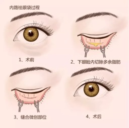 上眼皮长了脂肪块的图片:上眼皮脂肪块,原因、影响与解决方案 上眼皮长了脂肪块的图片:上眼皮脂肪块,原因、影响与解决方案