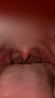 吞口水感觉喉咙有肉坨:吞口水感觉喉咙有肉坨?警惕这些潜在原因! 吞口水感觉喉咙有肉坨:吞口水感觉喉咙有肉坨?警惕这些潜在原因!