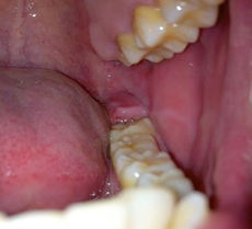 吞口水感觉喉咙有肉坨:吞口水感觉喉咙有肉坨?警惕这些潜在原因! 吞口水感觉喉咙有肉坨:吞口水感觉喉咙有肉坨?警惕这些潜在原因!