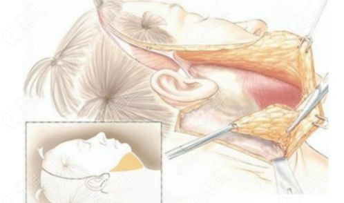 小拉皮手术全过程:小拉皮手术全解析,从麻醉到恢复的完整指南 小拉皮手术全过程:小拉皮手术全解析,从麻醉到恢复的完整指南