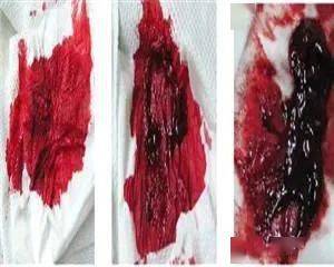 便血鲜红色会是癌症吗:便血鲜红色会是癌症吗?真相在这里! 便血鲜红色会是癌症吗:便血鲜红色会是癌症吗?真相在这里!