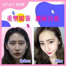 祛除眼袋方法有哪些:告别小熊猫眼!全面解析祛眼袋的多种方法 祛除眼袋方法有哪些:告别小熊猫眼!全面解析祛眼袋的多种方法