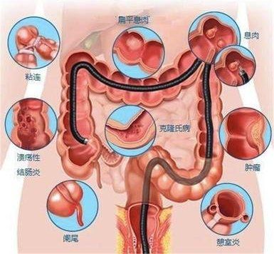 不想做肠镜怎么查肠道:不想做肠镜?这些肠道检查新方法了解一下