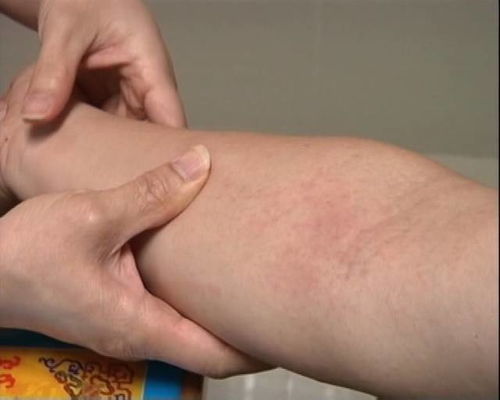 湿疹是毒气还是湿气:湿疹是毒气还是湿气?揭开皮肤过敏的真相